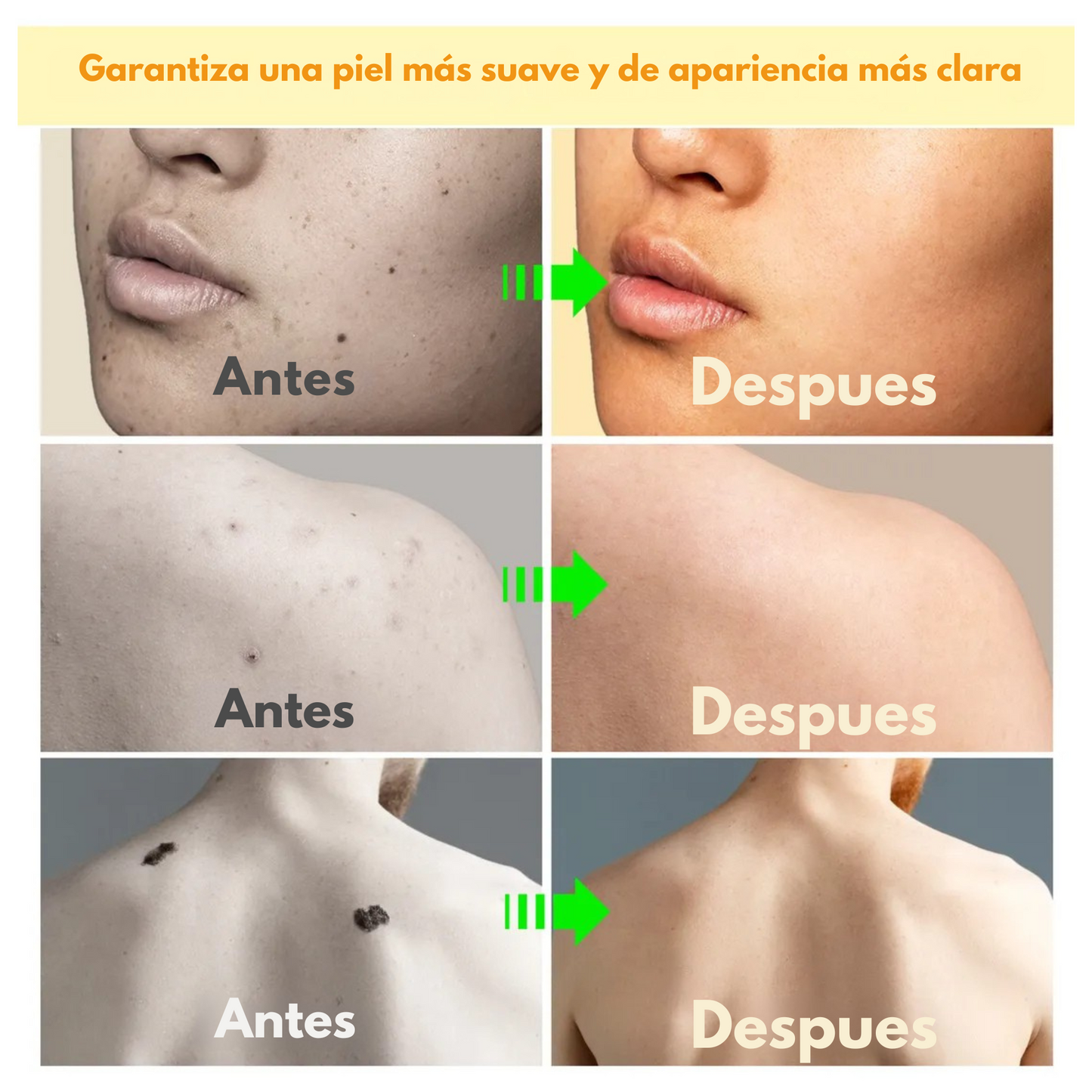 Spray Elimina Verrugas- Veneno De Abeja